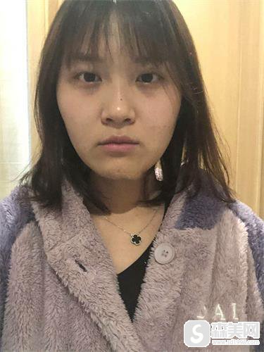 石家庄瑞贝尔医疗美容医院怎么样?专家信息,附双眼皮案例