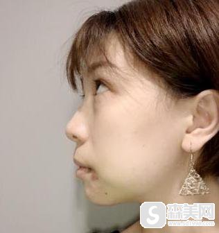 韩式改脸型手术怎么样？附手术案例果对比图