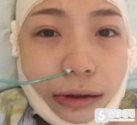韩式改脸型手术怎么样？附手术案例果对比图