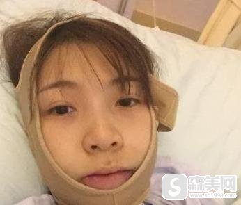 韩式改脸型手术怎么样？附手术案例果对比图