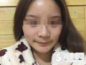 像素激光祛痘怎么样?相关信息+真实案例分享