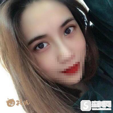 像素激光祛痘怎么样?相关信息+真实案例分享