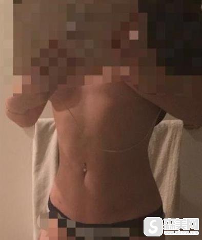 震动吸脂实战案例分享,手术全过程分享附果图