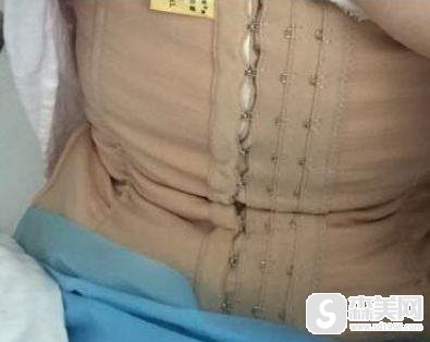 震动吸脂实战案例分享,手术全过程分享附果图