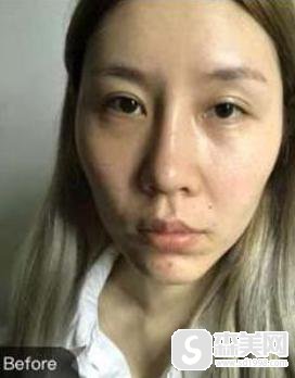 c8祛斑原理及案例,术后实际果图