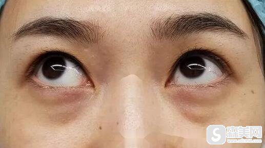 去眼袋手术多少钱？附祛眼袋案例术后果图