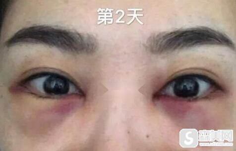 去眼袋手术多少钱？附祛眼袋案例术后果图