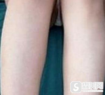 淄博壹美整形美容医院脱毛怎么样