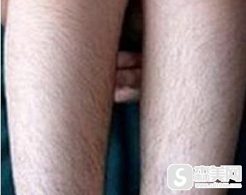 淄博壹美整形美容医院脱毛怎么样