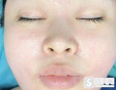 北京东方和谐医院冯斌医生面部吸脂怎么样?案例分享