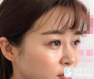 北京东方和谐医院冯斌医生面部吸脂怎么样?案例分享