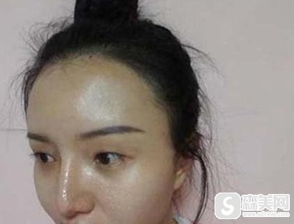 重医大附二院到底如何？附真实整形案例过程+术后果图