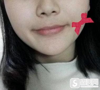 杭州格莱美微笑唇果如何？附真实案例对比