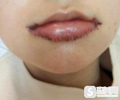 杭州格莱美微笑唇果如何？附真实案例对比