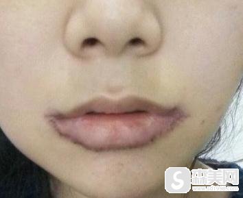 杭州格莱美微笑唇果如何？附真实案例对比