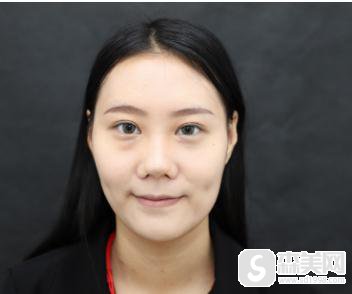 瑞兰玻尿酸隆鼻价格?温州和平医院案例分享