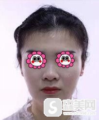 河南中医药大学第一附属医院好不好?做的隆鼻手术让我有哪些改变?