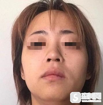 国字脸磨骨对比照片，看看我在做了磨骨后改变是不是特别的明X?