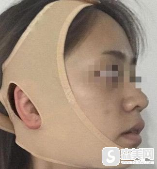 国字脸磨骨对比照片，看看我在做了磨骨后改变是不是特别的明X?