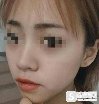 国字脸磨骨对比照片，看看我在做了磨骨后改变是不是特别的明X?