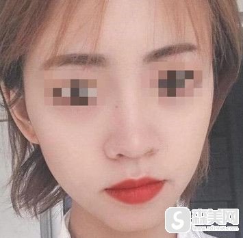 国字脸磨骨对比照片，看看我在做了磨骨后改变是不是特别的明X?