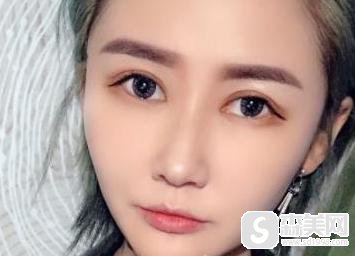 成都第二人民医院整形科怎么样？附真实隆鼻案例分享