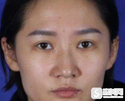 成都第二人民医院整形科怎么样？附真实隆鼻案例分享