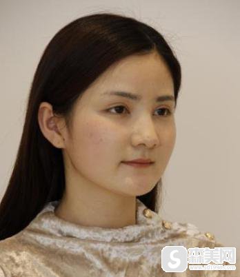 广州激光祛斑多少钱？附激光祛斑真实术后对比图！