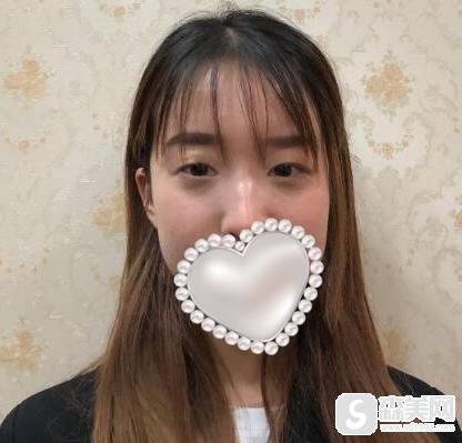 汕头华美医疗整形医院怎么样?附双眼皮案例分享