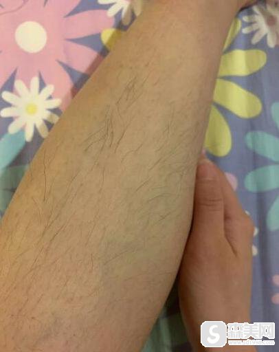 山大一院整形科激光脱毛怎么样?附激光脱毛案例分享