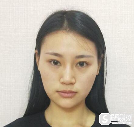 赵作钧医生的隆鼻手术如何?附专家信息及术后真实果对比图!