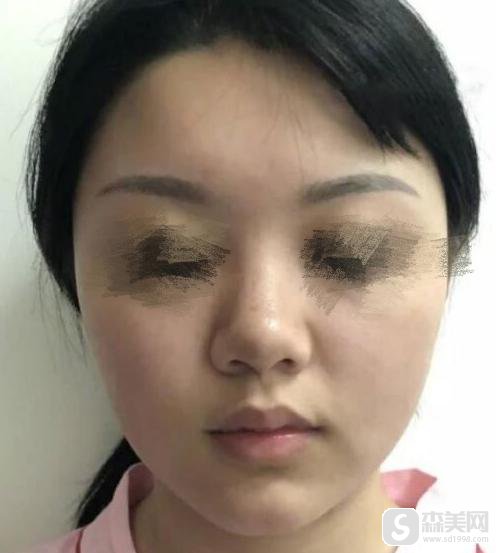 上海九院做隆鼻手术好不好？附隆鼻手术案例分享