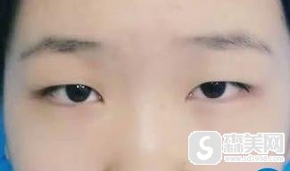 安徽合肥韩美整形医院怎么样？附双眼皮案例分享