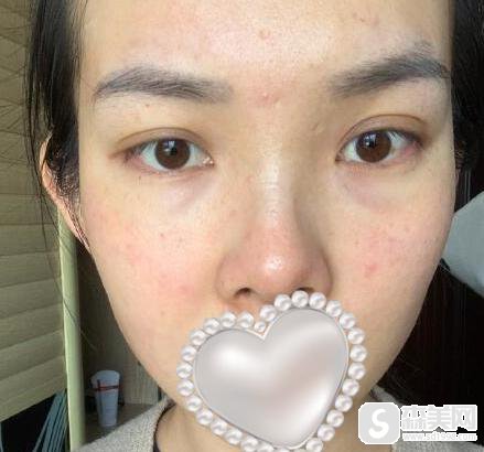 光子嫩肤的原理是什么？附光子嫩肤案例分享