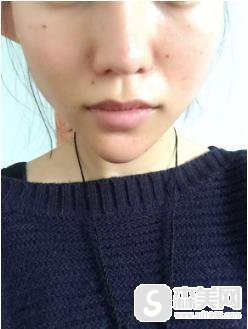 奥美定究竟是什么,取出手术真的很难吗?