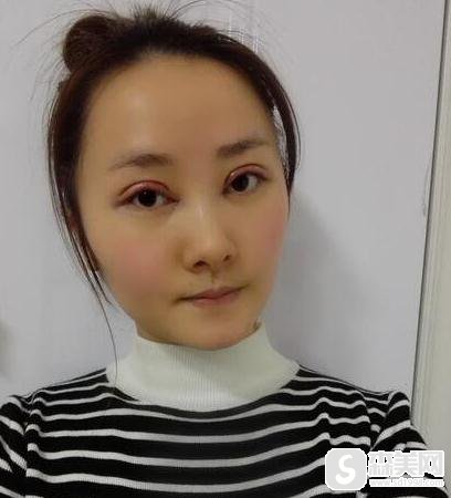 胡瑾双眼皮案例彻底拜拜小眼睛，附案例分享