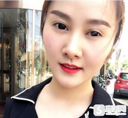 胡瑾双眼皮案例彻底拜拜小眼睛，附案例分享