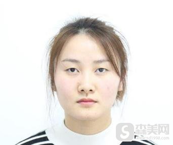 胡瑾双眼皮案例彻底拜拜小眼睛，附案例分享