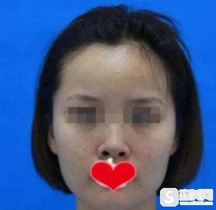 陈亮医生所做的朝天鼻果？90天恢复详情