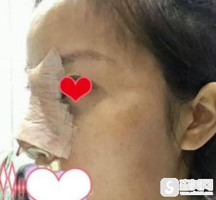 陈亮医生所做的朝天鼻果？90天恢复详情