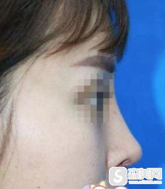 陈亮医生所做的朝天鼻果？90天恢复详情