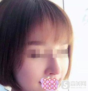 陈亮医生所做的朝天鼻果？90天恢复详情