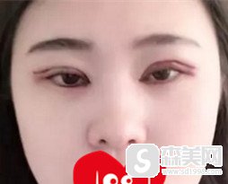 大连做双眼皮整形医院哪家好?华美整形真是好，双眼皮果完美又自然!