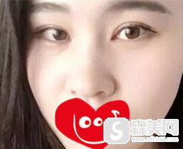 大连做双眼皮整形医院哪家好?华美整形真是好，双眼皮果完美又自然!