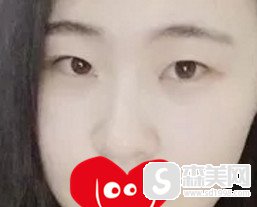 大连做双眼皮整形医院哪家好?华美整形真是好，双眼皮果完美又自然!