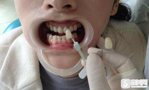 星沙做的烤瓷牙果怎么样?附前后对比图