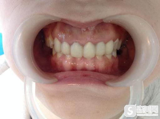 星沙做的烤瓷牙果怎么样?附前后对比图