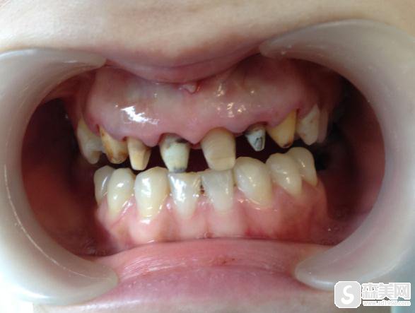 星沙做的烤瓷牙果怎么样?附前后对比图