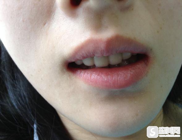 星沙做的烤瓷牙果怎么样?附前后对比图