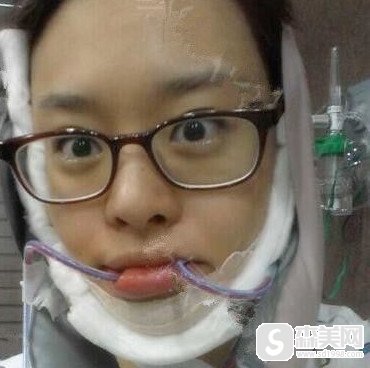 【下巴截骨前移+下巴截骨缩短】宋茂启的精选的截骨案例的分享